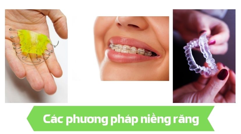 Các phương pháp niềng răng