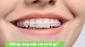 Niềng răng mắc cài sứ là gì - Nha khoa An An
