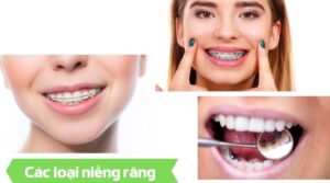 Các loại niềng răng - Nha khoa An An