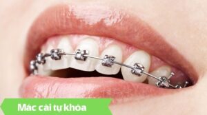 Niềng răng mắc cài kim loại tự khóa tại nha khoa An An