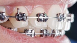 Niềng răng mắc cài kim loại tại nha khoa AN AN