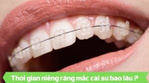 Thơi gian niềng răng mắc cài sứ - Nha khoa An An