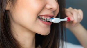 Vệ sinh răng thật kỹ khi niềng răng