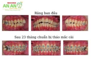 Hình ảnh niềng răng thực tế sau 23 tháng chuẩn bị tháo mắc cài - ca 1
