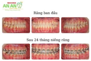 Hình ảnh niềng răng thực tế tại Nha khoa An An - Ca số 6