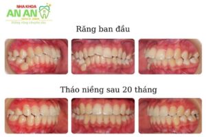 Hình ảnh thực tế niềng răng tại Nha khoa AN AN - ca số 10