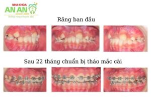 Hình ảnh niềng răng thực tế sau 22 tháng tại Nha khoa AN AN -Ca số 2
