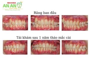 Hình ảnh niềng răng thực tế tái khám sau 1 năm - Ca số 3
