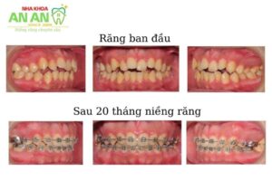 Hình ảnh niềng răng thực tế tại nha khoa AN AN - Ca số 5