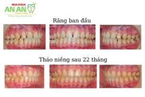 hình ảnh niềng răng thực tế tại Nha khoa An An - Ca số 7