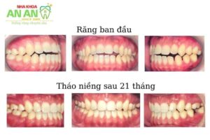 HÌnh ảnh niềng răng thực tế tại Nha khoa AN AN - Ca 8