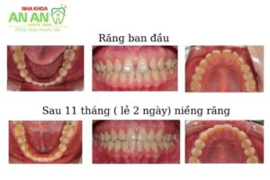 Hình ảnh niềng răng thực tế tại nha khoa AN AN Quận 8 - Ca số 4