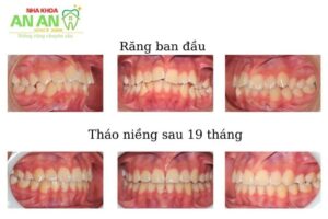 hình ảnh niềng răng thực tế tại Nha khoa An An - Ca số 9