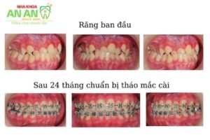 Hình ảnh thực tế niềng răng tại Nha khoa An An - Ca số 11