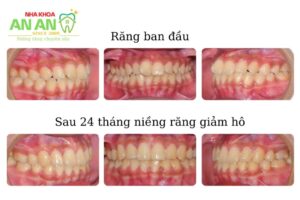 Ca niềng răng thực tế giảm hô tại nha khoa AN AN quận 8 tphcm