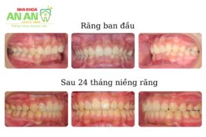 Hình ảnh niềng răng thực tế tại Nha khoa An An - ca số 13