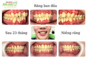Hình ảnh thực tế niềng răng tại Nha khoa An An - Ca số 12