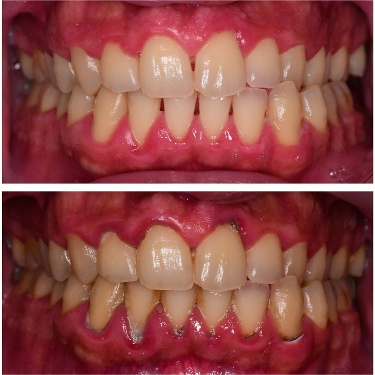 Viêm nướu do mảng bám lâu ngày