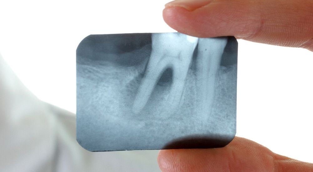 Viêm nha chu gây tiêu xương - ảnh phim X Quang