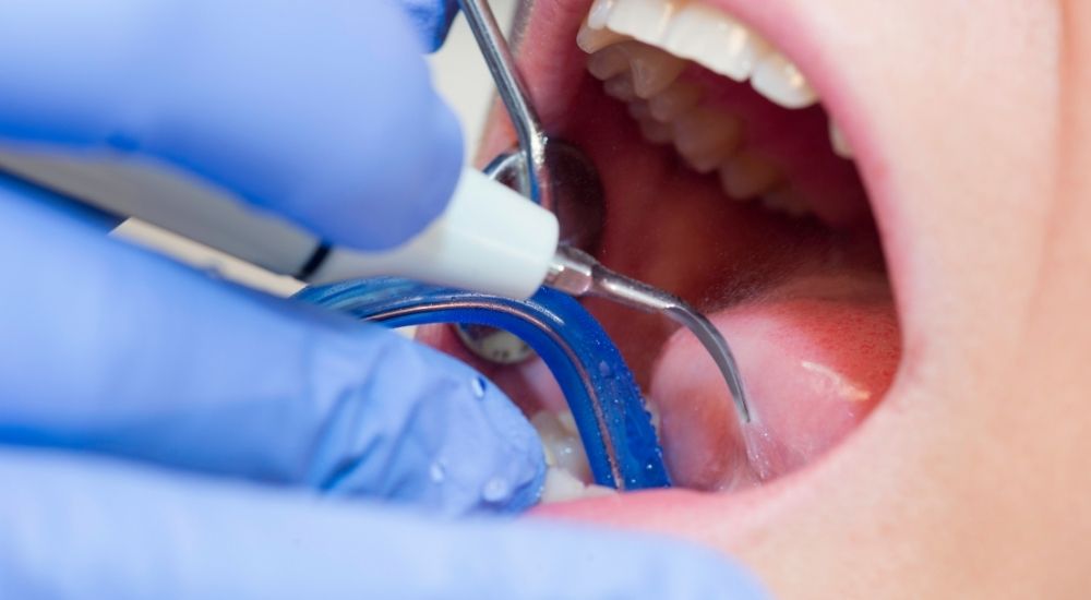 Cạo vôi răng bằng máy siêu âm tại nha khoa AN AN -Quận 8- HCM