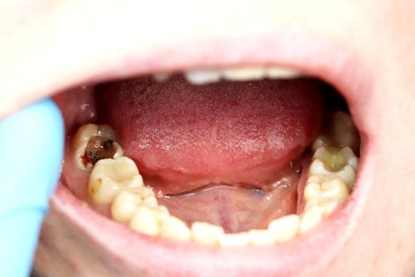 Răng sâu vỡ lớn cần chữa tủy - lấy tủy - Nha khoa An An Quận 8 TPHCM