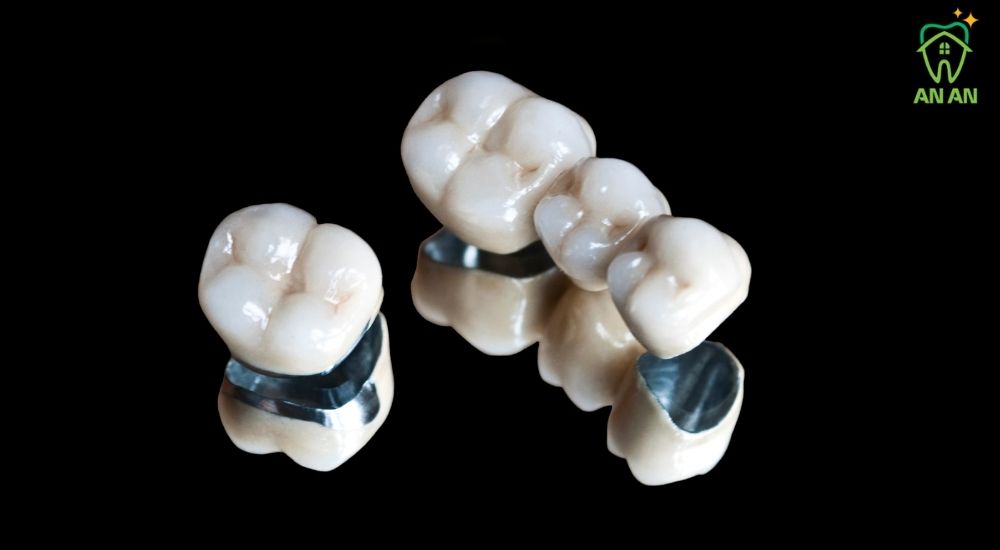 Răng sứ có sườn Cr-Ni