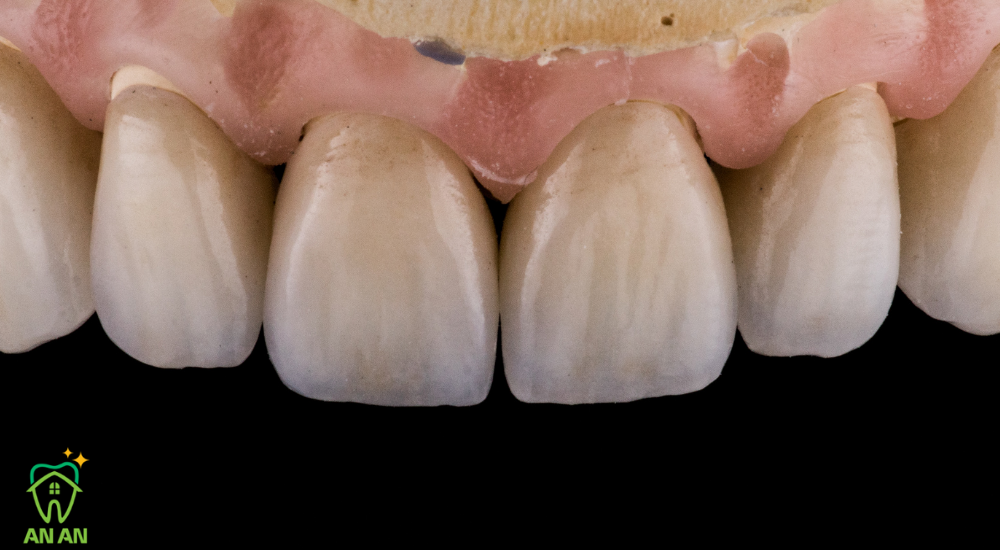Răng sứ tại Nha khoa An An