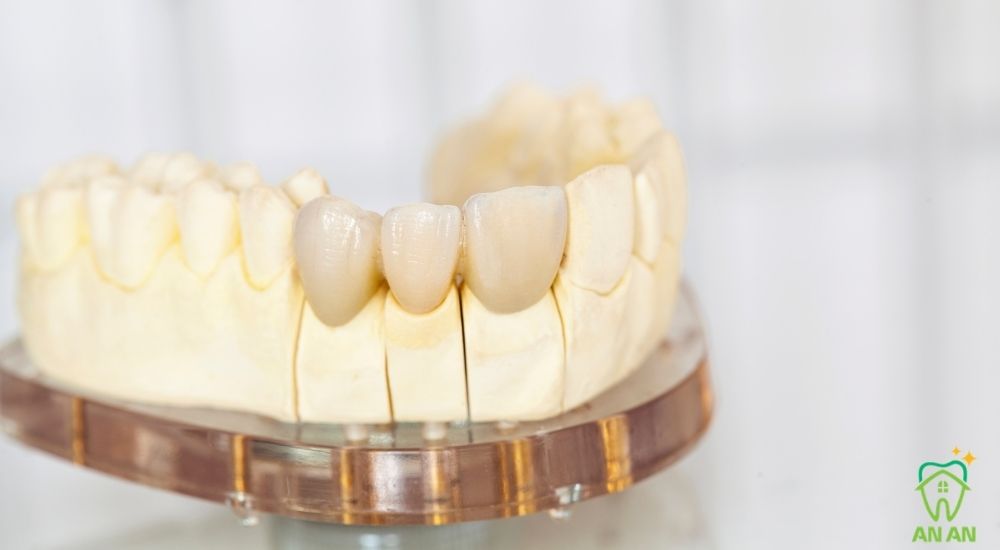 Răng sứ Titan có dáng răng và màu tự nhiên - Bọc | Trồng | Làm răng sứ - Nha khoa An An Quận 8 HCM