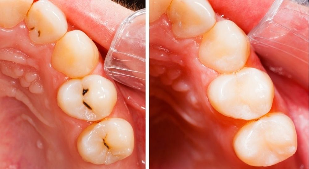 Cách Trám Răng Composite: Quy Trình Thực Hiện Và Những Điều Cần Biết 2 Trám răng composite tại Nha khoa AN AN Quận 8 HCM
