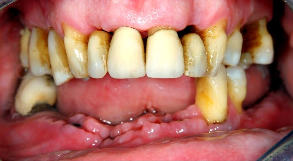 Vôi răng gây viêm nha chu dẫn đến mất răng