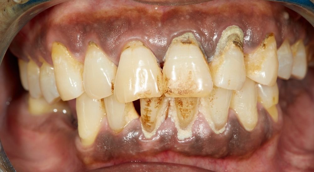 Vôi răng lâu ngày gây mất thẩm mỹ và viêm nướu - Nha khoa An An- Quận 8-HCM