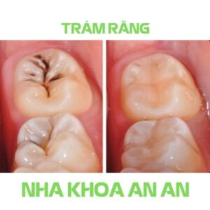 Trám răng Nha khoa An An Quận 8 HCM
