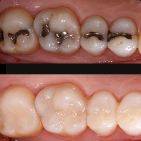 Bệnh nhân thay đổi miếng trám Amalgam bằng Composite thẩm mỹ