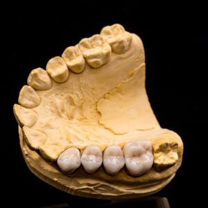 Độ tuổi nào trồng được răng sứ?