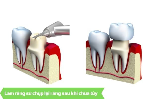 Làm răng sứ chụp lại răng sau khi chữa tủy - lấy tủy