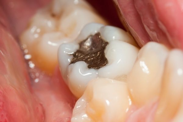 Trám răng bằng Amalgam tại Nha khoa An An Quận 8 TPHCM