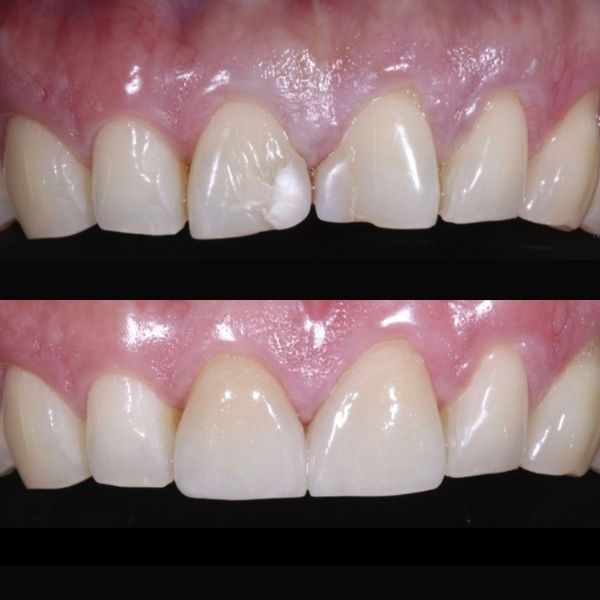 Trám răng bằng Composite tại Nha khoa An An Quận 8 HCM