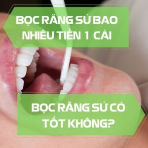 boc-rang-su-bao-nhieu-tien-1-cai-boc-rang-su-co-tot-khong