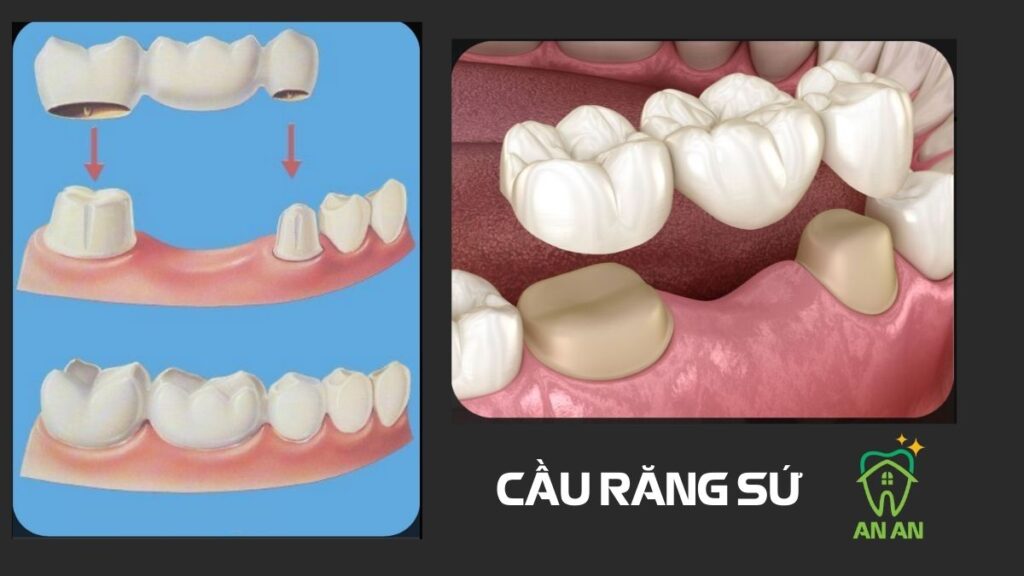 Trồng răng sứ bằng phương pháp cầu răng