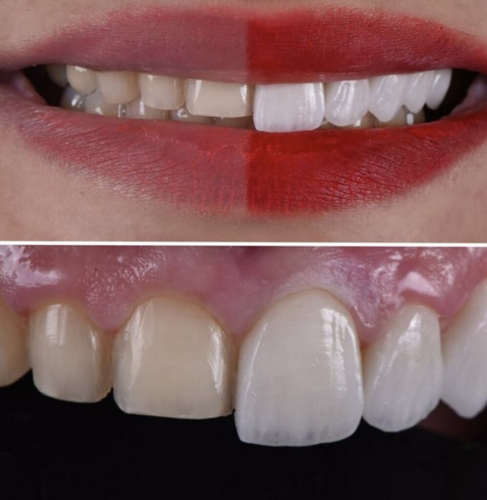 Mặt dán răng sứ veneer giúp cải thiện màu sắc răng