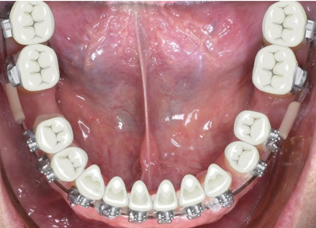 Nhổ răng để niềng răng