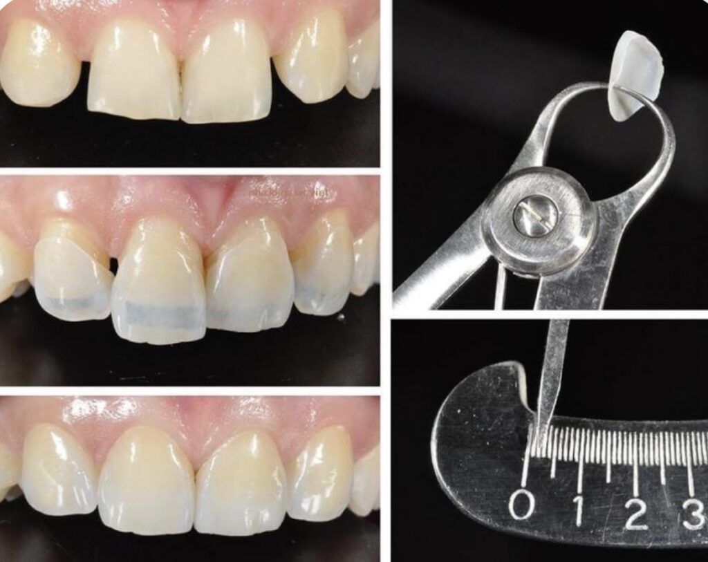 Mặt dán răng sứ Veneer giúp bảo vệ bề mặt răng, khắc phục khuyết điểm