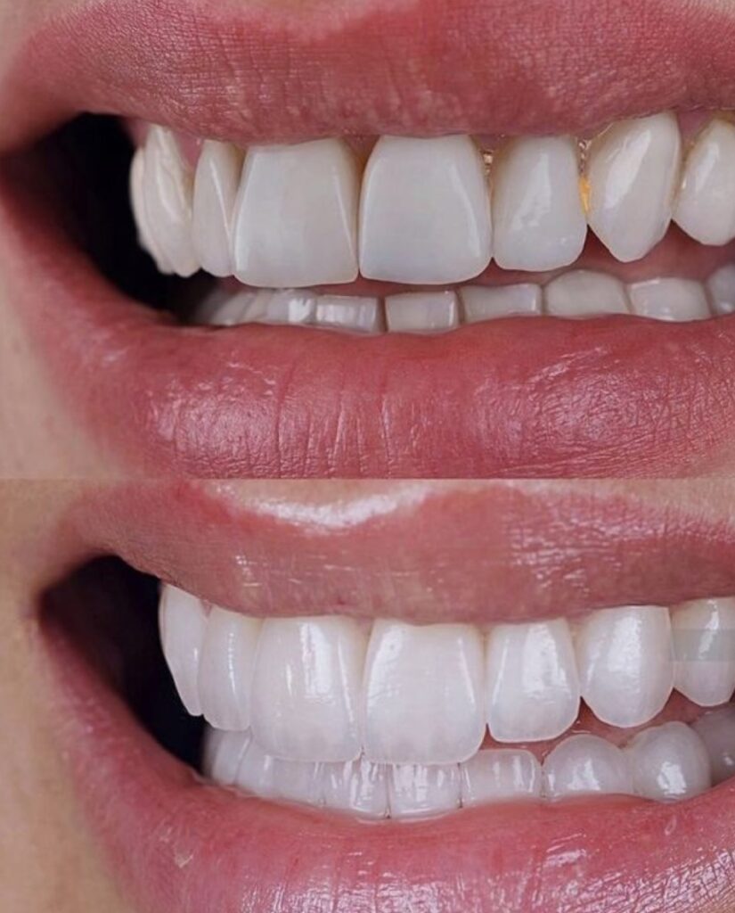 Veneer giúp cải thiện hình dáng răng
