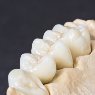 Cầu răng sứ là gì? Cầu răng sứ zirconia