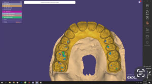 Thiết kế răng sứ bằng phần mềm