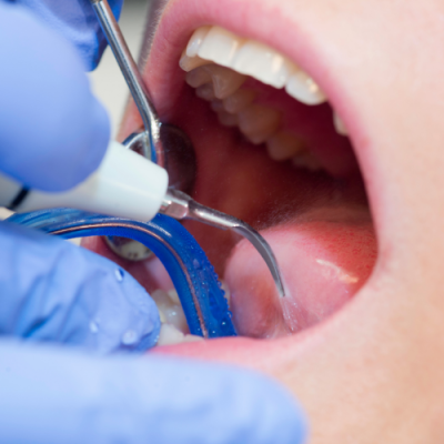 Cạo vôi răng bằng máy siêu âm