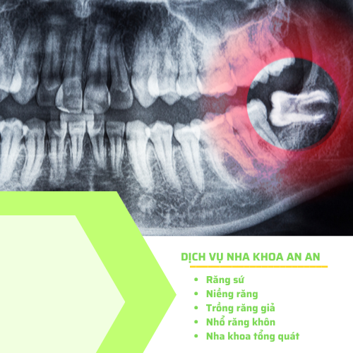 Vì sao khách hàng lựa chọn Nha khoa An An – Nha khoa Quận 8 3 Dịch vụ nhổ răng