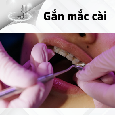 Gắn mắc cài lên răng và cố định dây cung