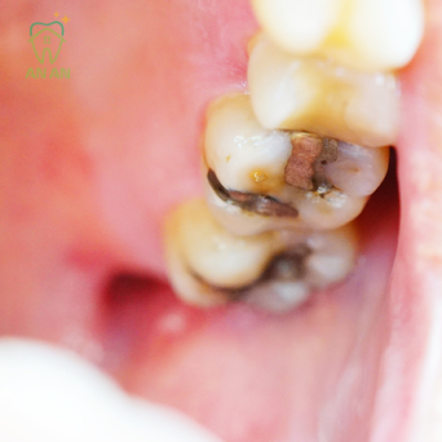 Miếng trám răng amalgam cũ bị hở, cần trám lại