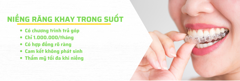 Niềng răng khay trong suốt